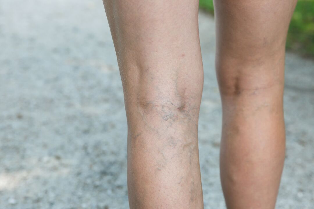 The exercise program for varicose veins should be discussed with your doctor. 